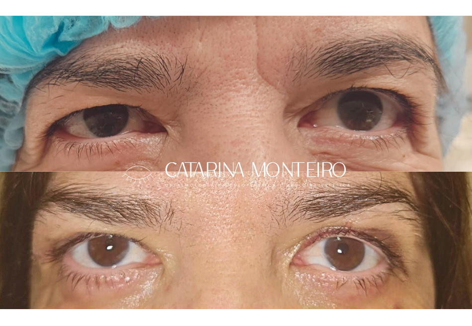 blefaroplastia_before_after_CatarinaMonteiro_Oftalmologia