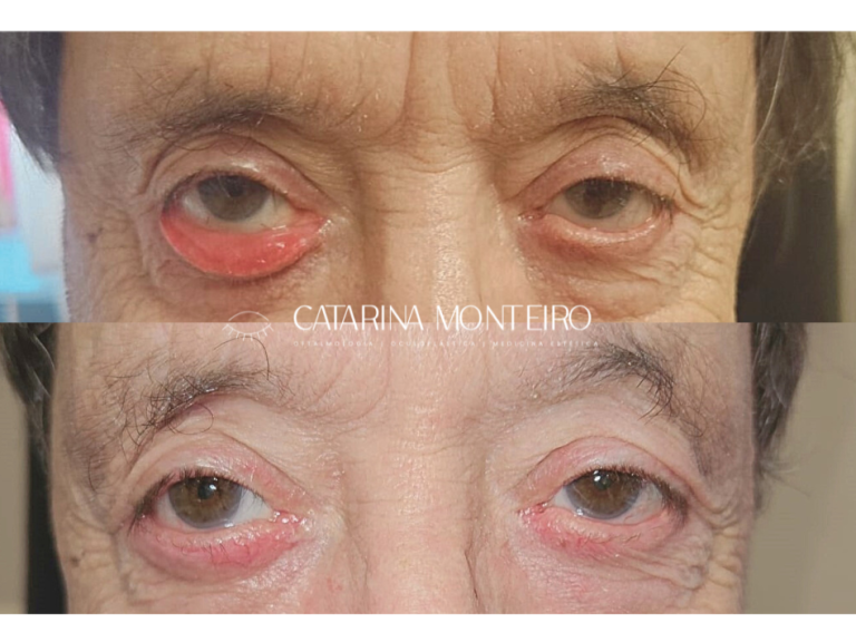 ectropion_before_after_CatarinaMonteiro_Oftalmologia