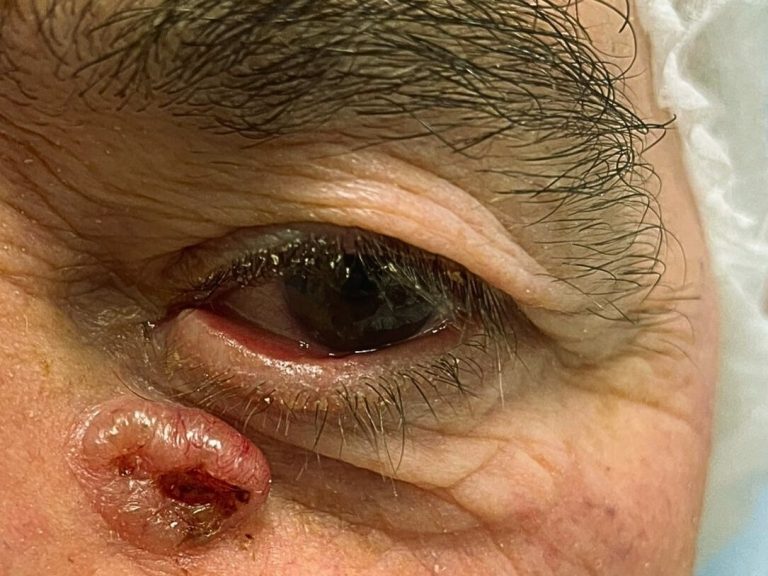 oncologia_ocular_tumor_cbc_tear_CatarinaMonteiro_oftalmologia