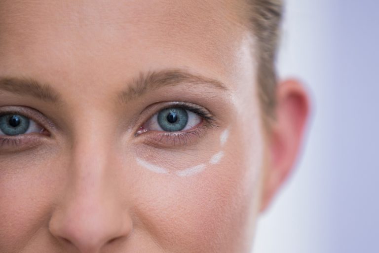Woman with marks drawn for botox procedure
